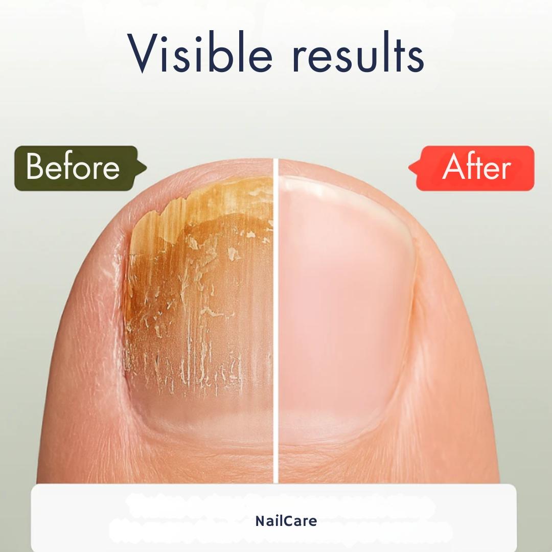 NailCare - Nail Repair Serum